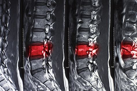 Spinal compression fracture 